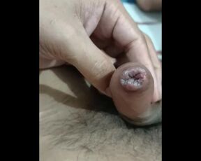 Syphilis (sexual transmitted disease) made my dick looking swallen. look at it